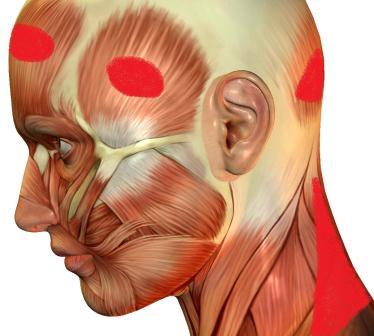 Cervicogenic Headaches Pain Points